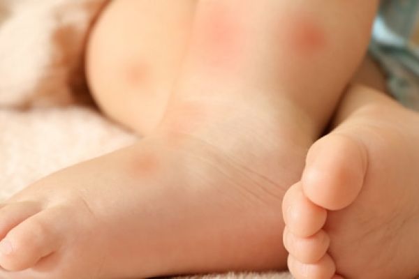 ما هي  حساسية الجلد عند الاطفال وكيف يمكن علاجها؟
